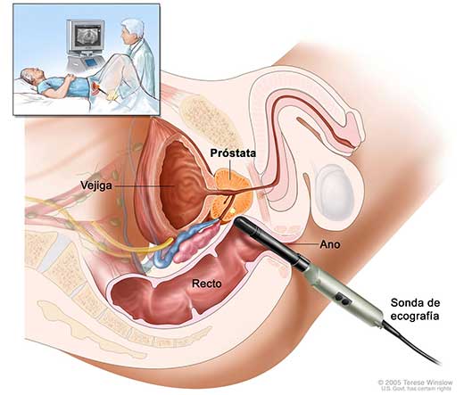 Cirugia Prostatica