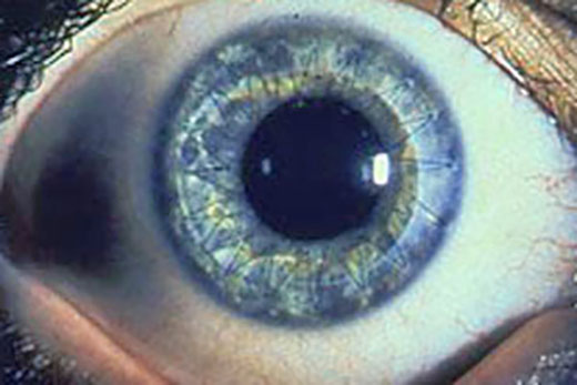 Cornea