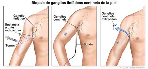 Sentinel lymph